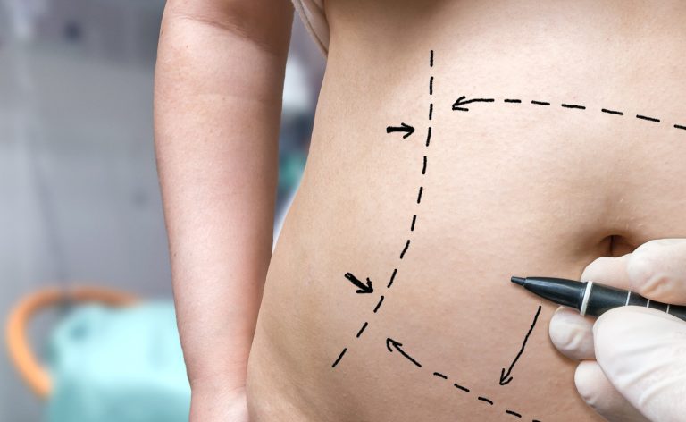 How Long After Pregnancy Should I Wait to Get a Tummy Tuck?