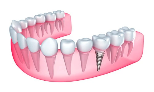 What You Need to Know About Getting Dental Implants In Kansas City