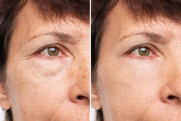 How Blepharoplasty Can Improve Your Vision